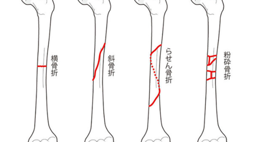 私自身は骨折未経験